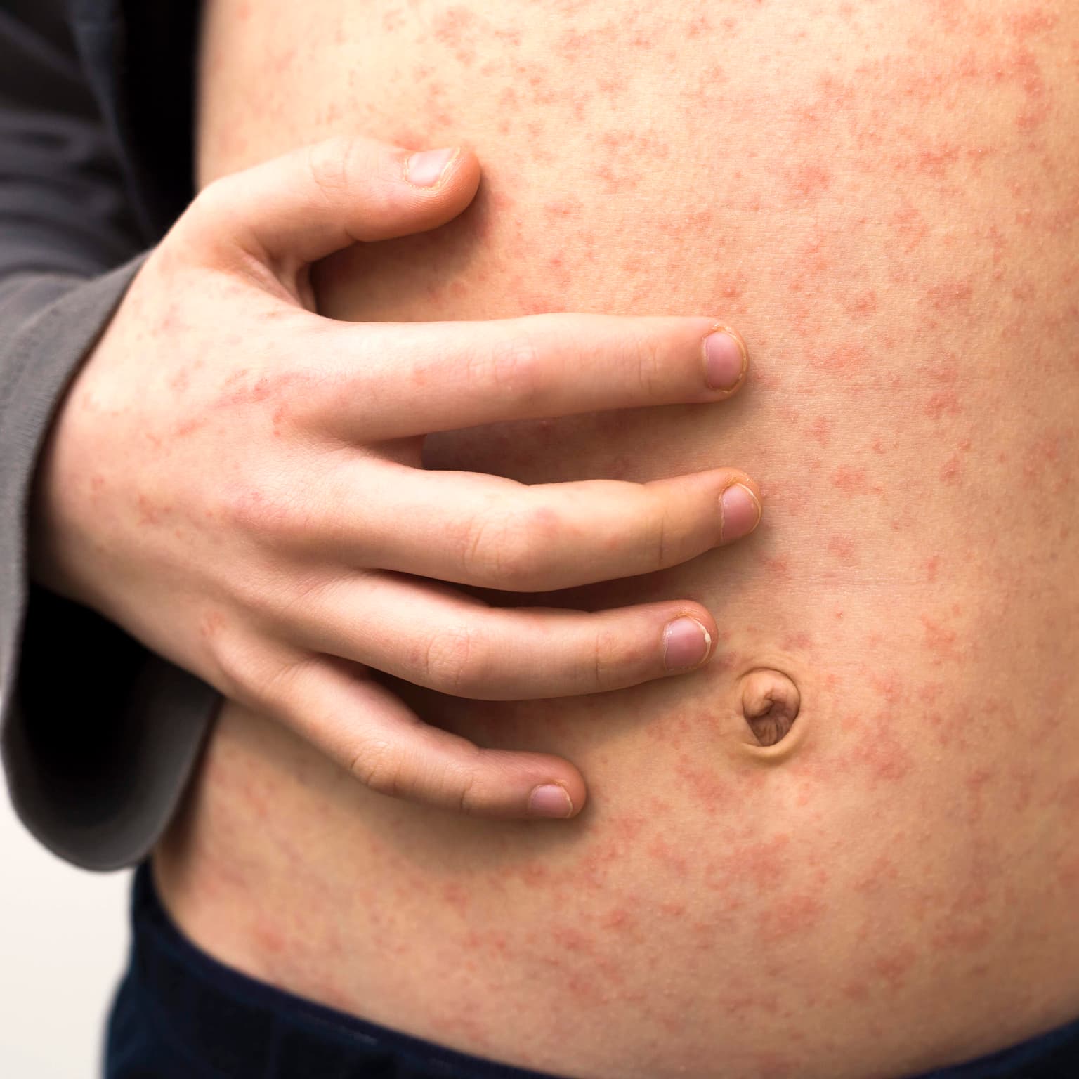 Measles is spreading. Are you safe? artwork