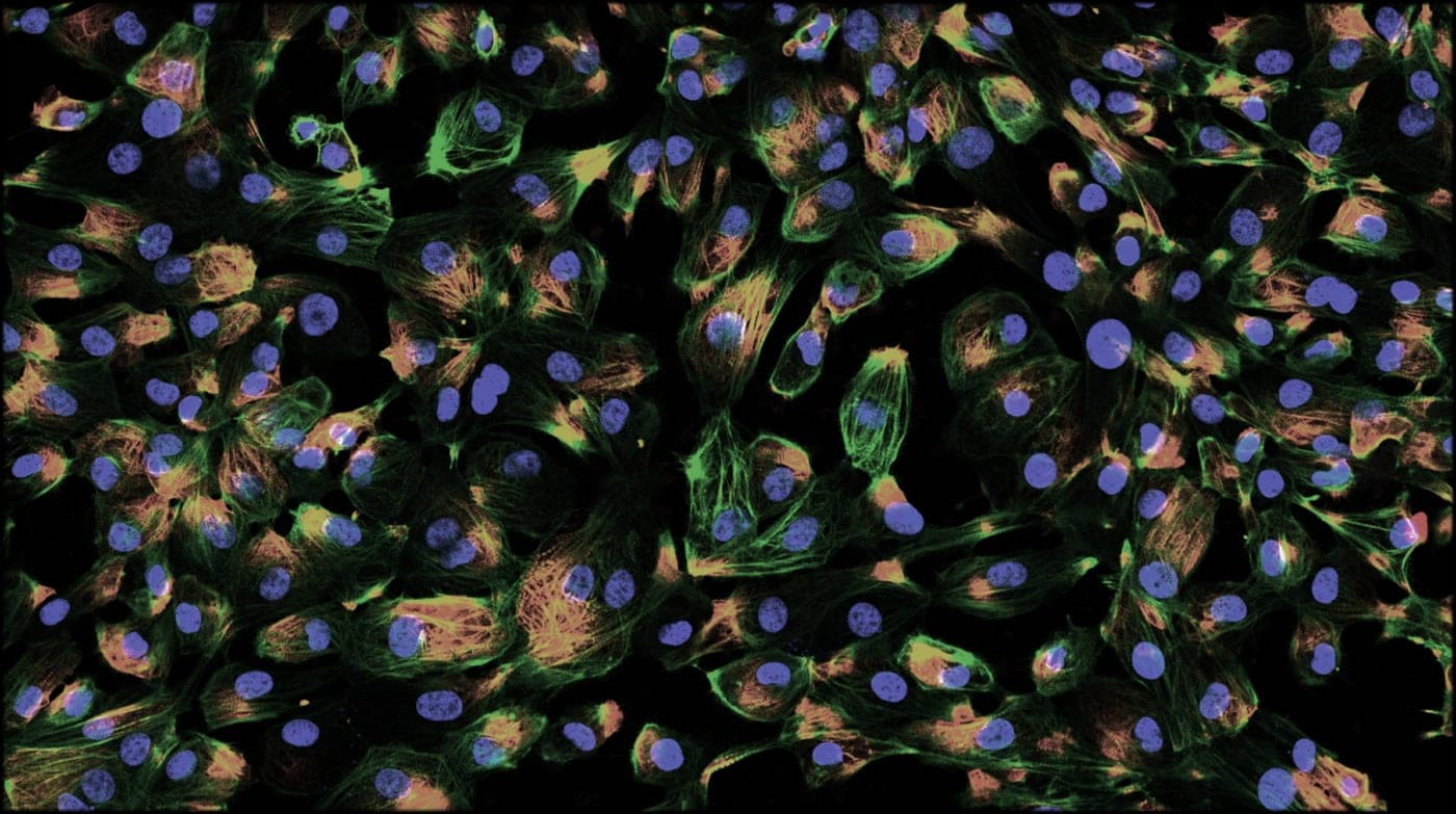 Knee arthritis and stem cells | Alzheimer's and women | spider venom and hearts | Maturity-onset diabetes and genetic testing artwork