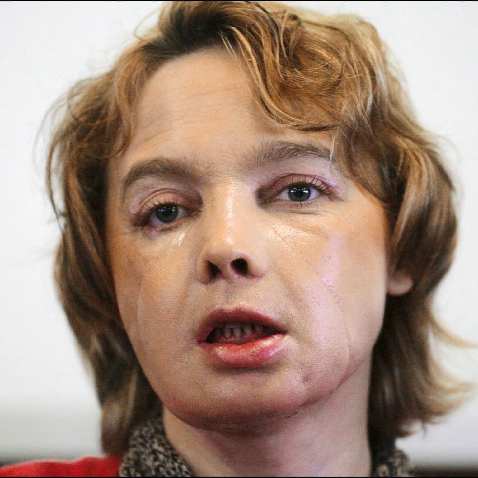 The ‘guinea pigs’ who had face transplant surgery artwork