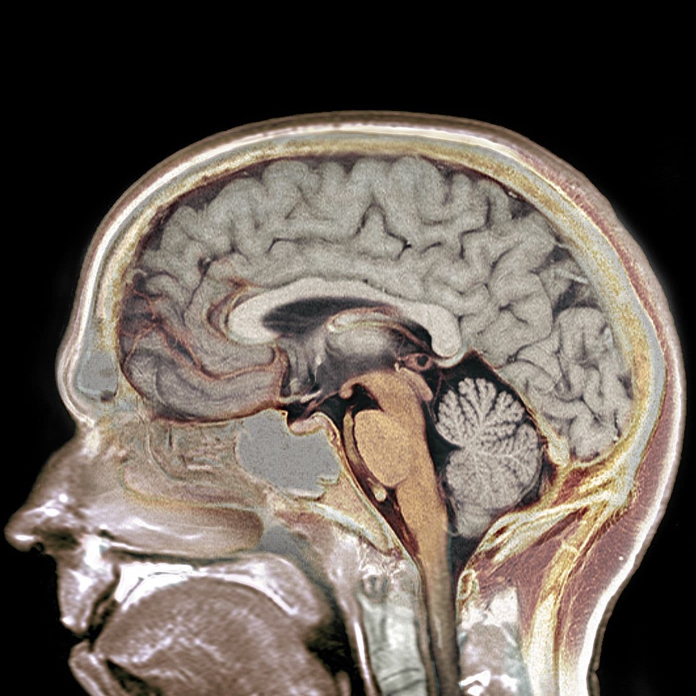 Concussions with Leonard Marshall artwork