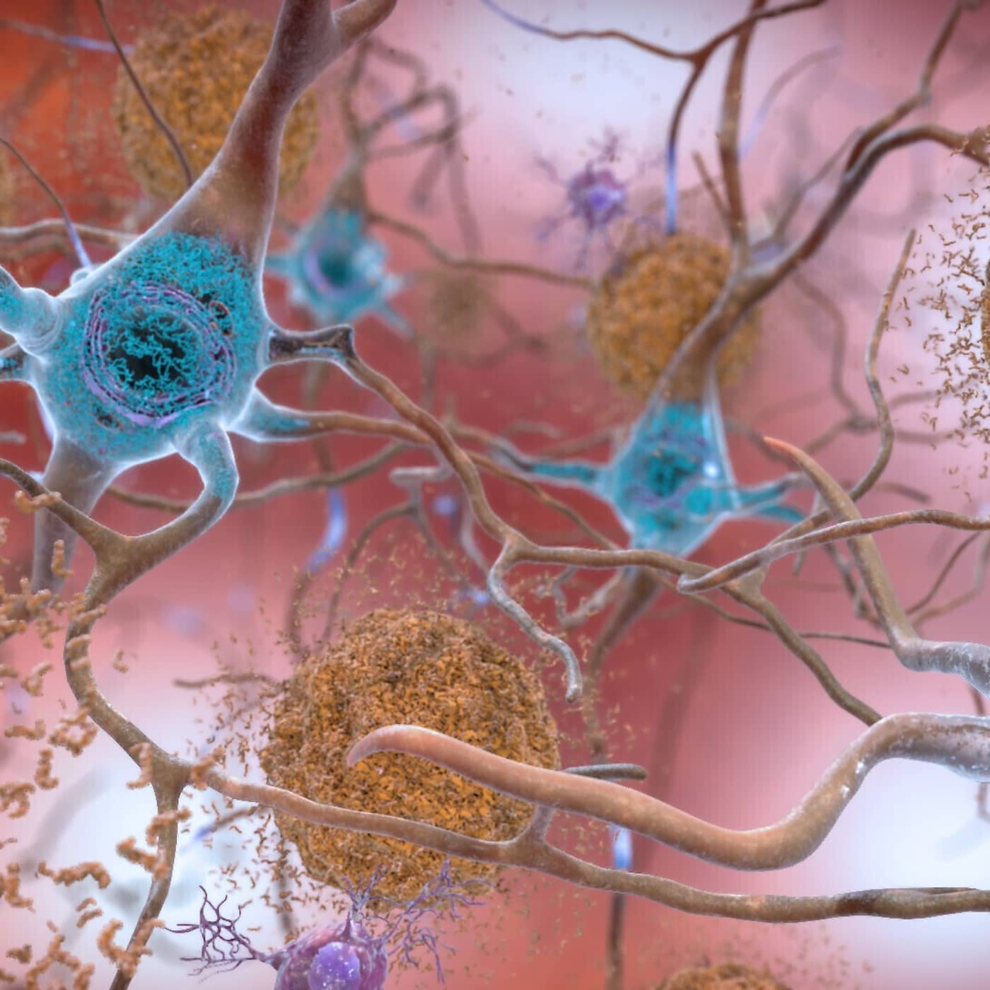 Därför splittras forskarna om de nya medicinerna mot alzheimer i Sverige artwork
