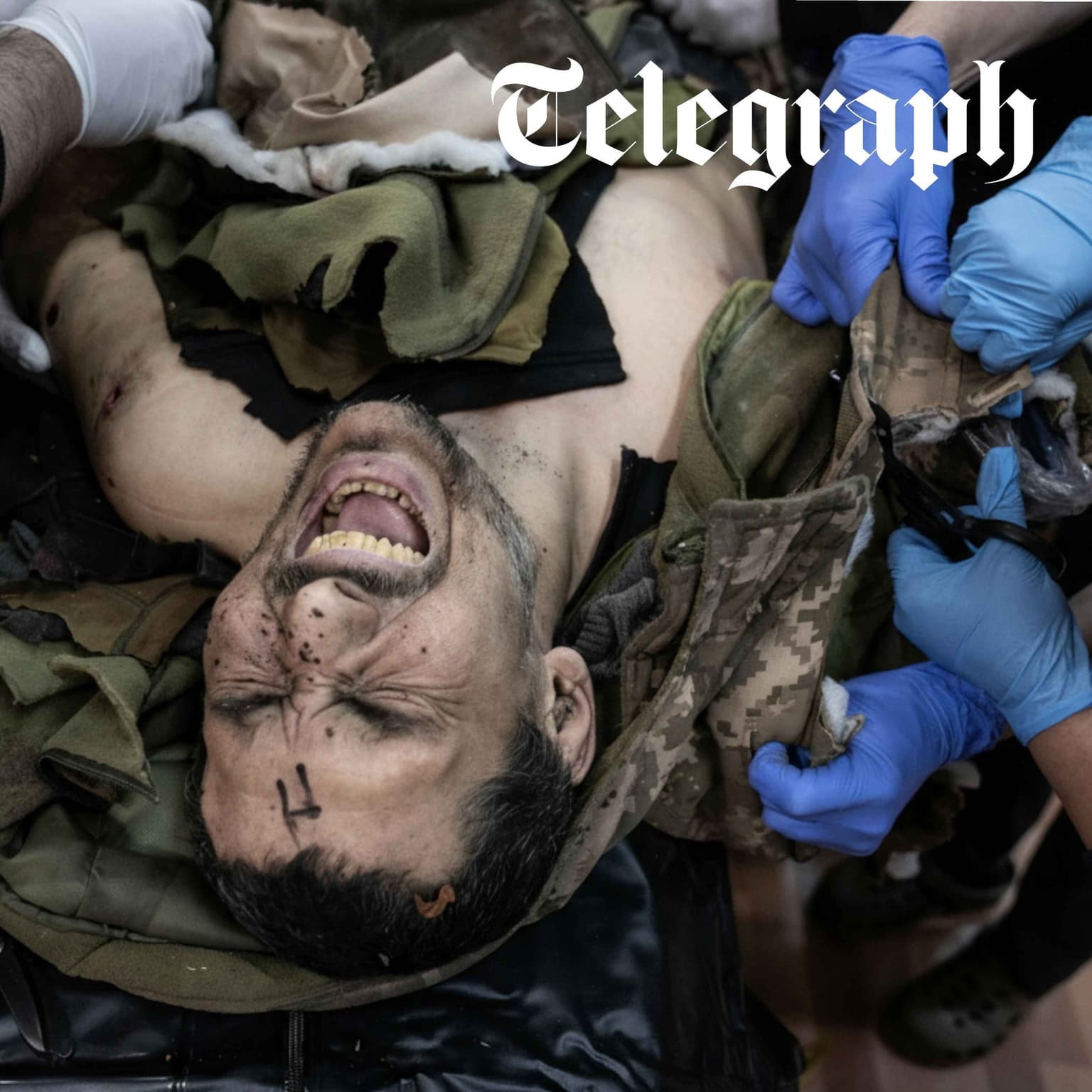 Why Ukraine's troops are facing an amputation crisis artwork