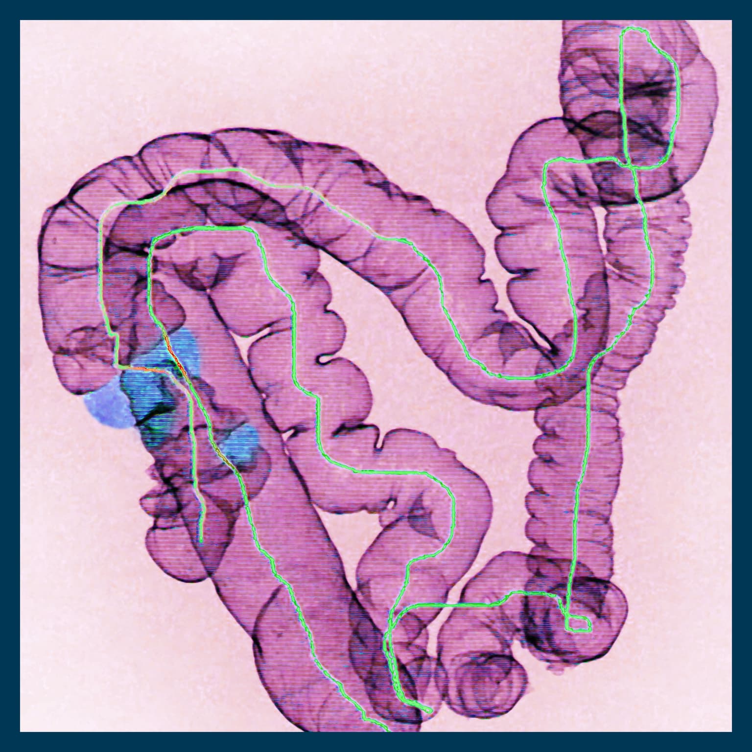 Why are more young people getting bowel cancer? artwork