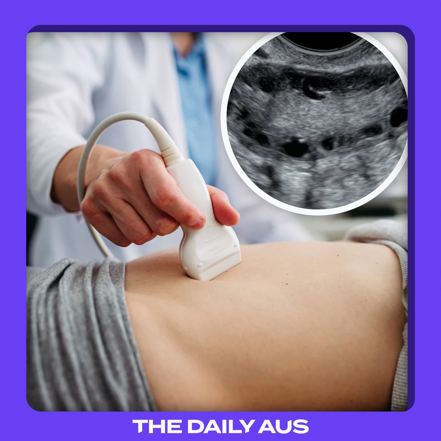 Why is PCOS getting a new name? artwork